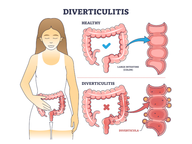 Diverticulite: facteurs de risque et récidive